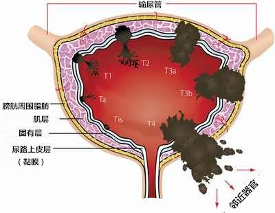 膀胱腫瘤最新治療方法，探索與理解