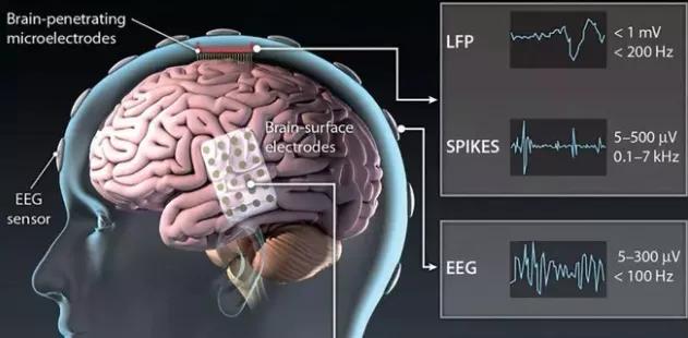 腦機接口最新突破治療精神疾病